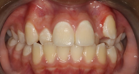 Before Teeth